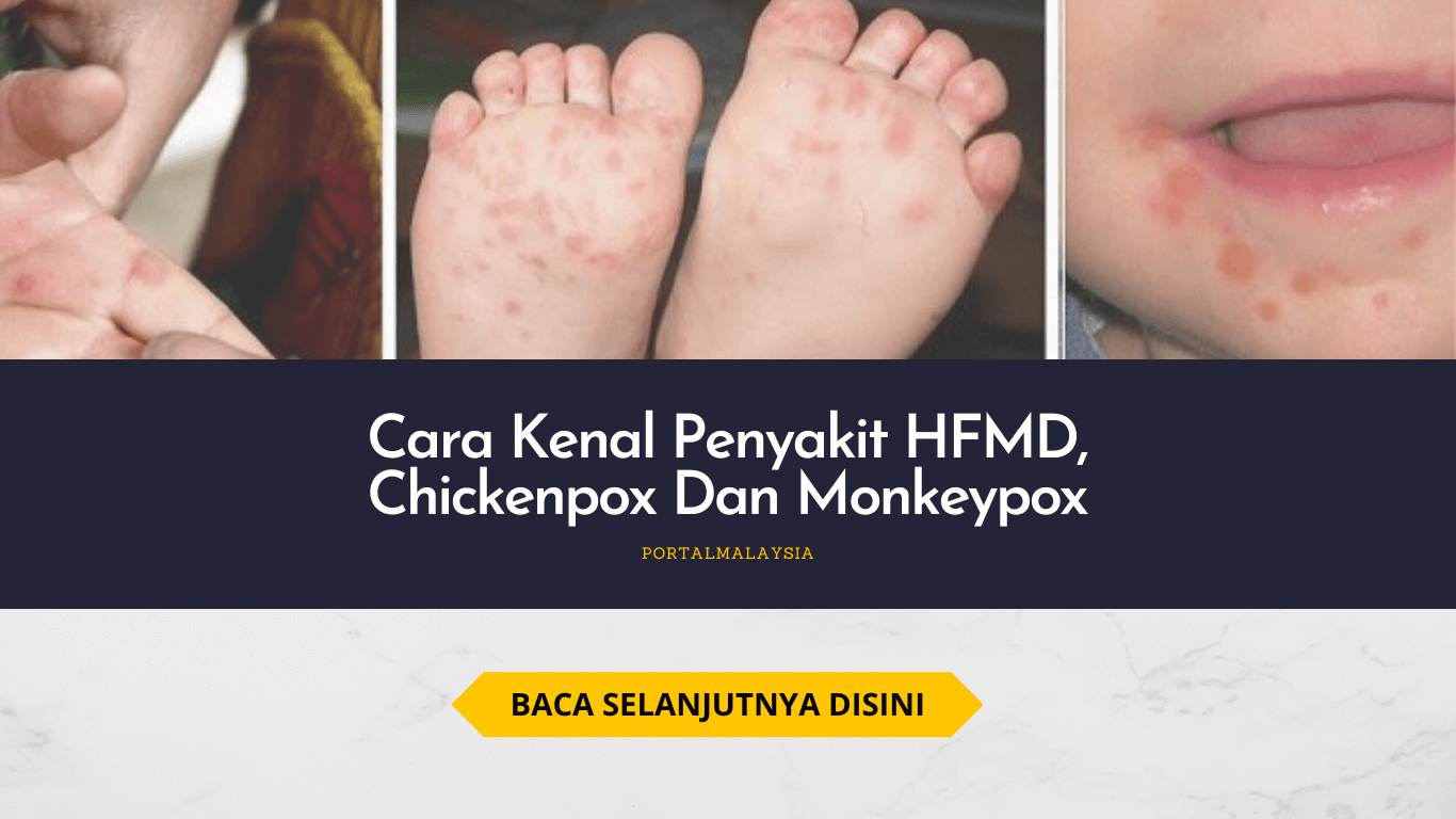 Cara Kenal Penyakit HFMD, Chickenpox Dan Monkeypox